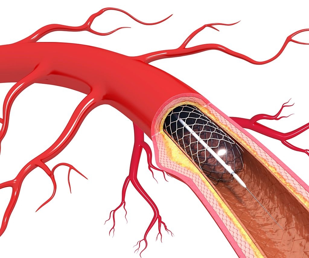 Balloon angioplasty. Computer artwork of a stent being placed in a narrowed blood vessel.